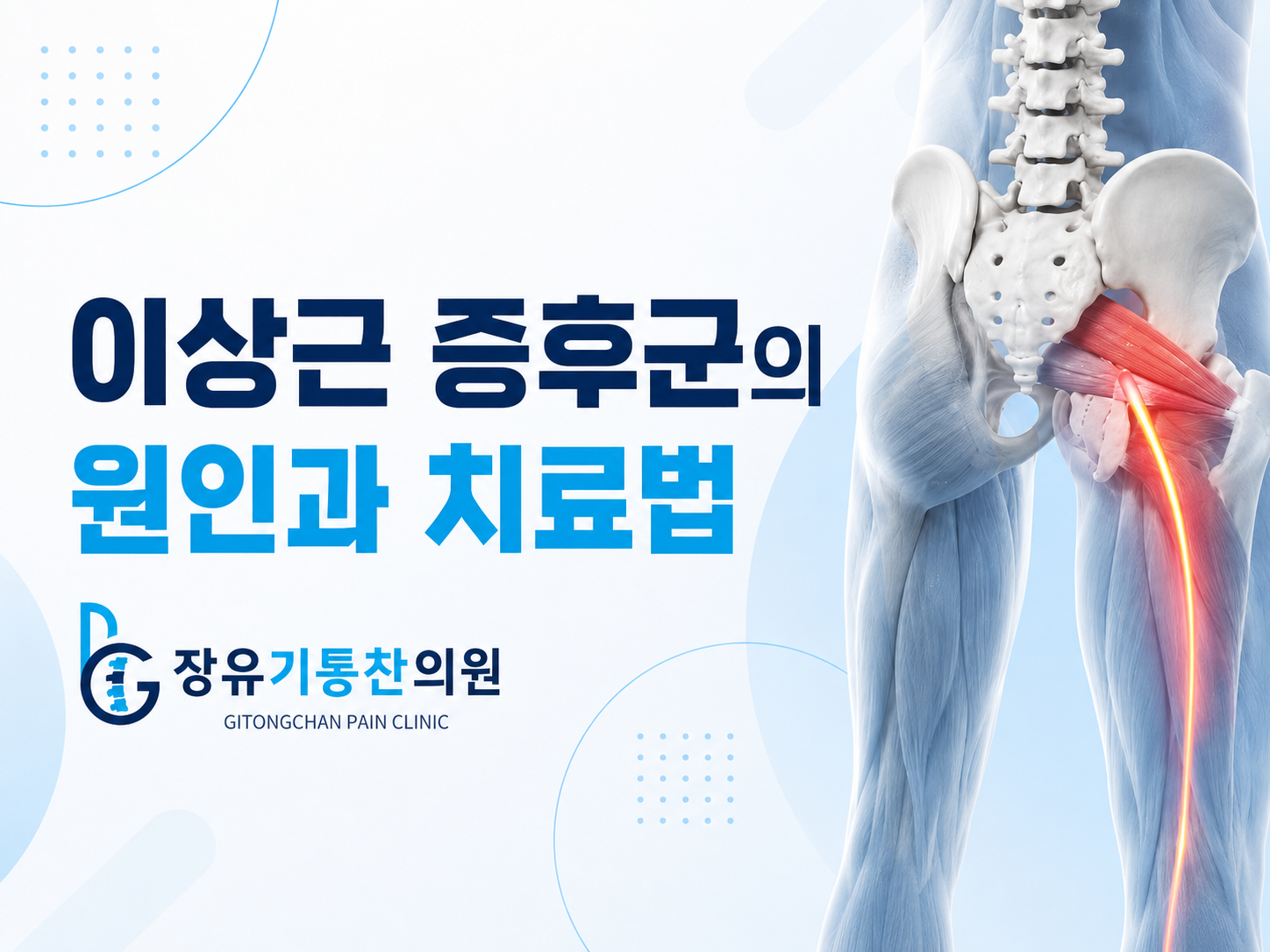 러닝 후 겪는 엉덩이 통증, 이상근증후군의 원인과 치료법
